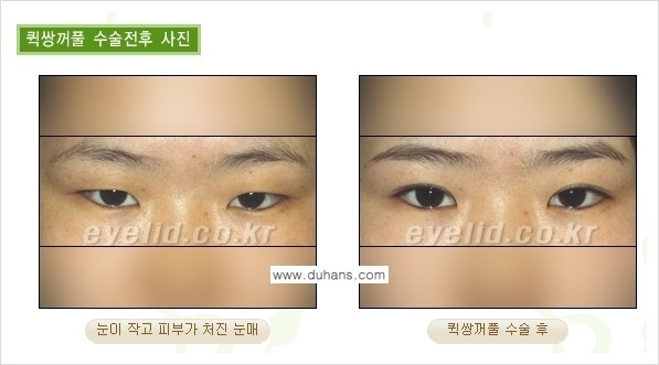 [두한성형외과 경쟁력 눈성형] - [퀵쌍꺼풀(부분절개법) 수술 안내] 관련 이미지 18