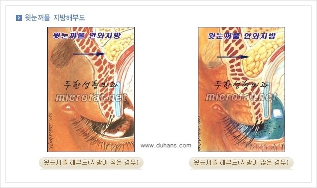 [두한성형외과 경쟁력 지방제거] - [눈밑지방제거, 눈위(윗눈꺼풀)지방제거 안내] 관련 이미지 4
