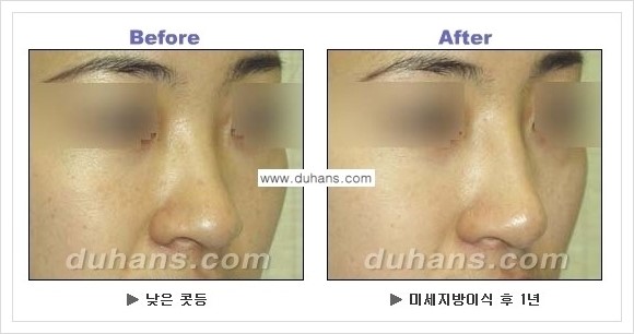 [두한성형외과 경쟁력 코성형] - [코높힘 미세지방이식 정보 안내] 관련 이미지 10