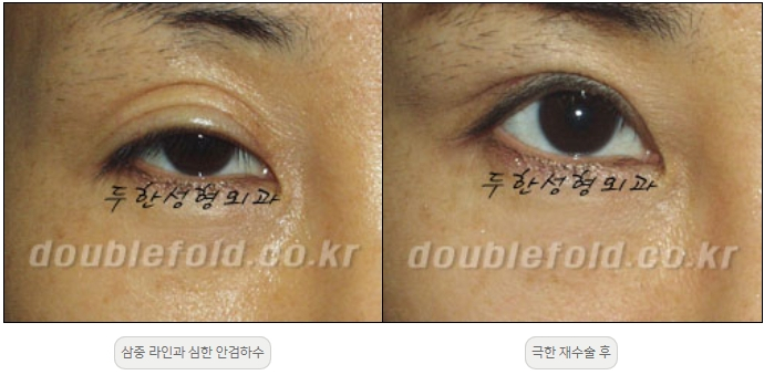 [Duhan Plastic Surgery Double Eyelid Revision] - [Thick Double Eyelid Line] image 55
