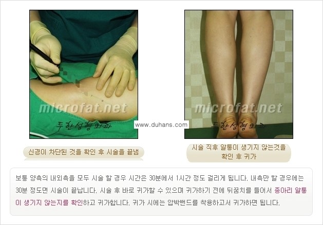 [두한성형외과 경쟁력 멀티종아리성형] - [초음파 유도 비절개 선택적 신경차단술의 효과] 관련 이미지 16