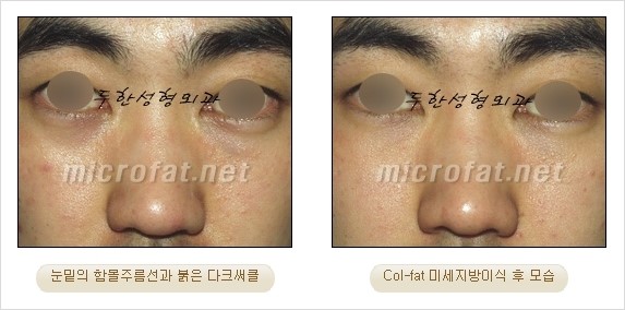 [두한성형외과 경쟁력 눈밑성형] - [Dr. 컬럼 - 눈밑 다크써클의 치료 방법과 치료 효과] 관련 이미지 8