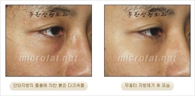 두한성형외과 눈밑수술 - 다크서클 수술 전후 관리 안내 관련 이미지 80