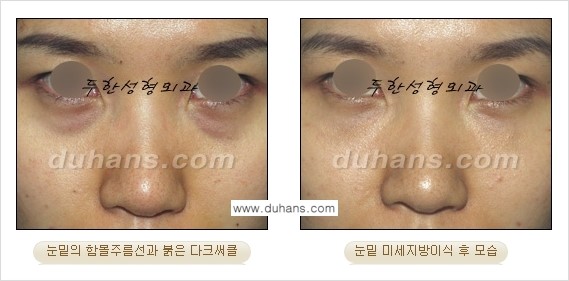 [두한성형외과 FOCUS 눈밑성형] - [다크써클의 치료방법 -  콜펫(Col-fat) 눈밑 미세지방이식 ⑤] 관련 이미지 7