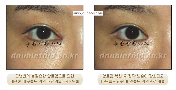 [두한성형외과 경쟁력 쌍꺼풀 재수술, 극한 재수술] - [쌍꺼풀 재수술에서 극복해야 할 극한의 상황과 문제들] 관련 이미지 10