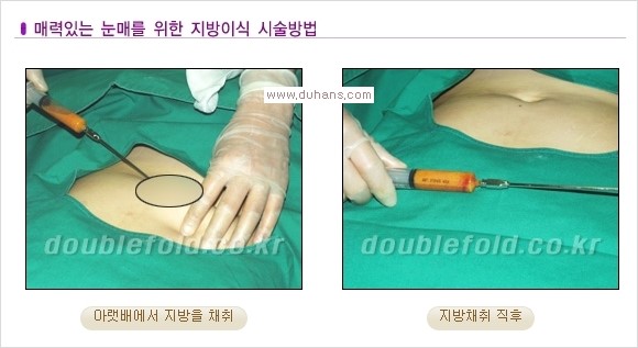 ​⁠⁠[두한성형외과 경쟁력 쌍꺼풀 재수술, 극한 눈재수술] - [지방이식으로 눈매와 쌍꺼풀 라인을 교정] 관련 이미지 4