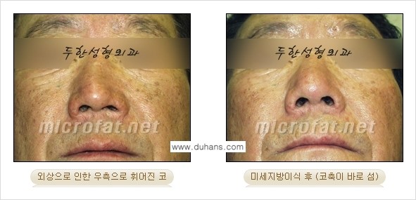 ​[두한성형외과의 No.1 경쟁력 미세(자가)지방이식] - [코높힘 미세(자가)지방이식 ②] 관련 이미지 5