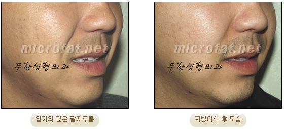Wrinkle Improvement, Duhan Plastic Surgery - Mouth Lines, Nasolabial Folds image 21