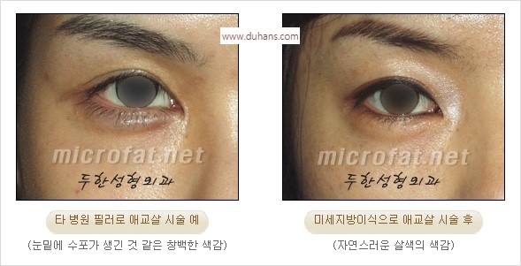 [두한성형외과 경쟁력 눈밑성형] - [눈밑애교살 시술을 위한 미세지방이식] 관련 이미지 12
