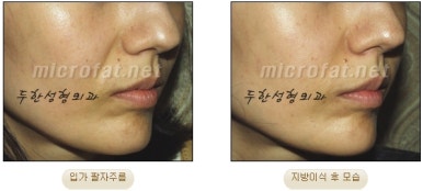 [Duhan Plastic Surgery Face Fat Grafting] - [Reducing Mouth Corners Wrinkles and Nasolabial Folds] image 19