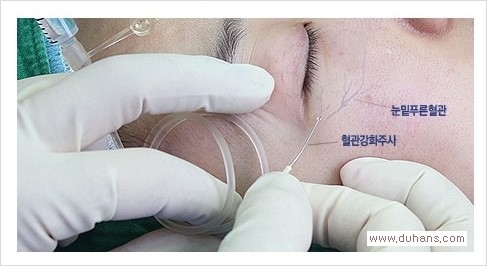 [두한성형외과 경쟁력 눈밑성형] - [눈밑 푸른 혈관 치료방법] 관련 이미지 3