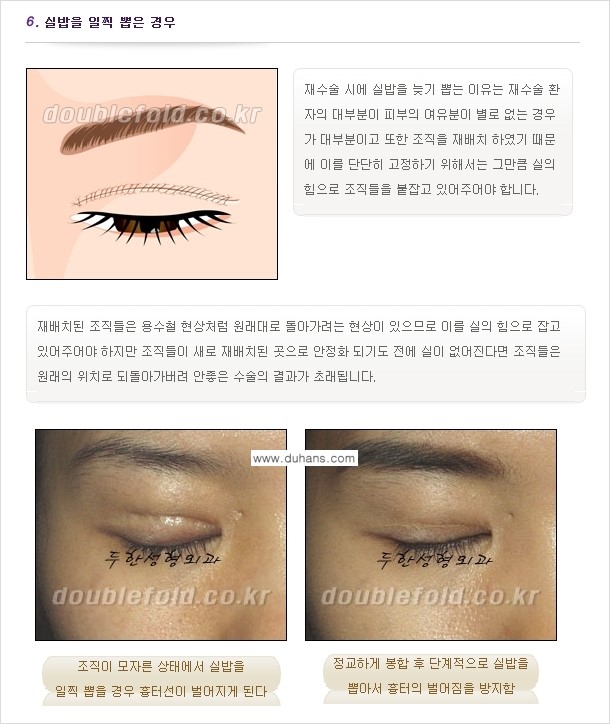[두한성형외과 경쟁력 쌍꺼풀 재수술, 극한 눈재수술] - [쌍꺼풀 재수술, 눈 재수술의 실패 원인] 관련 이미지 6