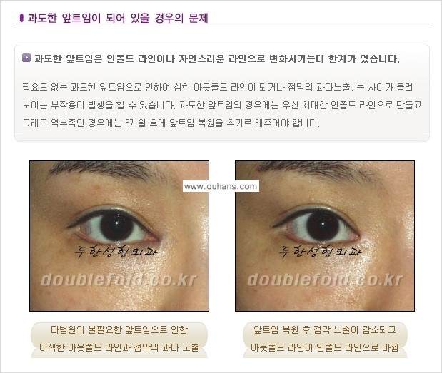 [두한성형외과 경쟁력 있는 쌍꺼풀 재수술] - [극복해야 할 극한의 상황과 문제들] 관련 이미지 7