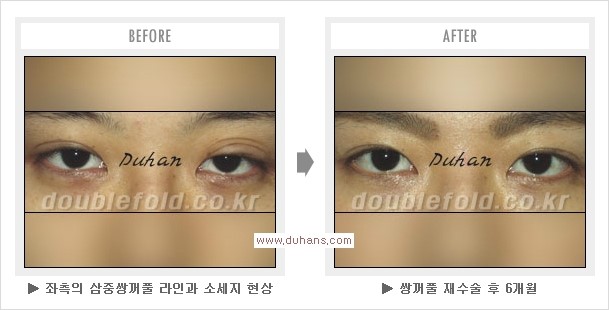 [두한성형외과 쌍꺼풀 재수술, 극한 눈재수술] - [재수술에 대한 자주하는 질문과 답변 안내] 관련 이미지 9