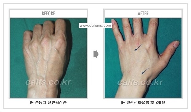 [두한성형외과 정맥류 치료] - [손, 팔 정맥확장증 사진자료 안내 ①] 관련 이미지 10