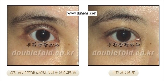 [두한성형외과 경쟁력 쌍꺼풀 재수술, 극한 눈재수술] - [망가진 쌍꺼풀 라인을 교정하는 극한 재수술을  위한 계획] 관련 이미지 11