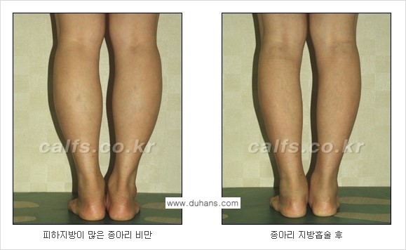 [두한성형외과 경쟁력 종아리성형] - [종아리 지방흡입 2.] 관련 이미지 7
