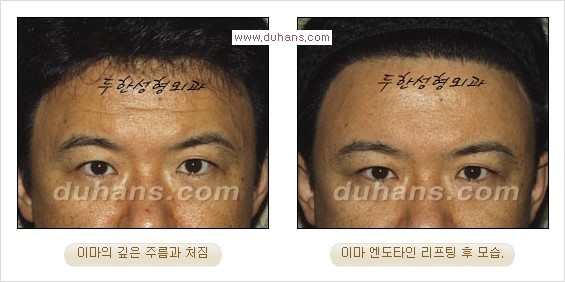 [두한성형외과 경쟁력 주름성형] - [눈썹거상, 앞볼처짐 개선의 엔도타인 리프팅] 관련 이미지 17