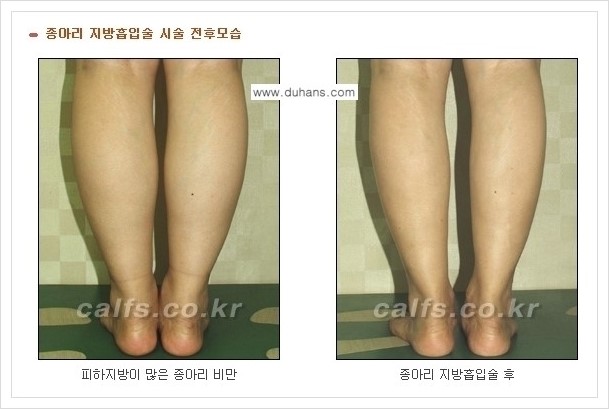 [두한성형외과 경쟁력 멀티종아리성형] - [나에게 맞는 종아리성형 방법의 종류 안내 3.] 관련 이미지 3