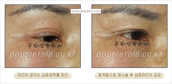 [두한성형외과 경쟁력 쌍꺼풀 재수술] - [삼중(세겹) 쌍꺼풀 라인, 눈꺼풀이 함몰된 삼중(세겹) 쌍꺼풀 라인 교정] 관련 이미지 2