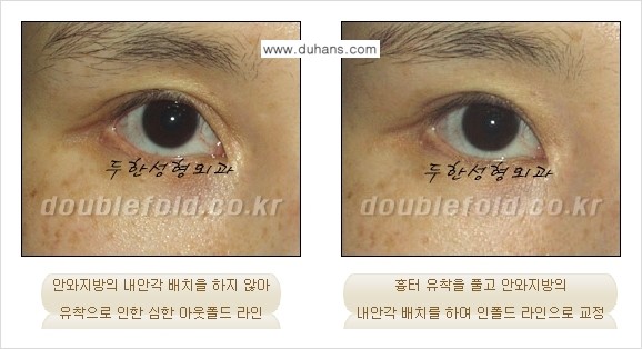 ​[두한성형외과] - [쌍꺼풀 재수술 클리닉의 특성과 자부심] 관련 이미지 7