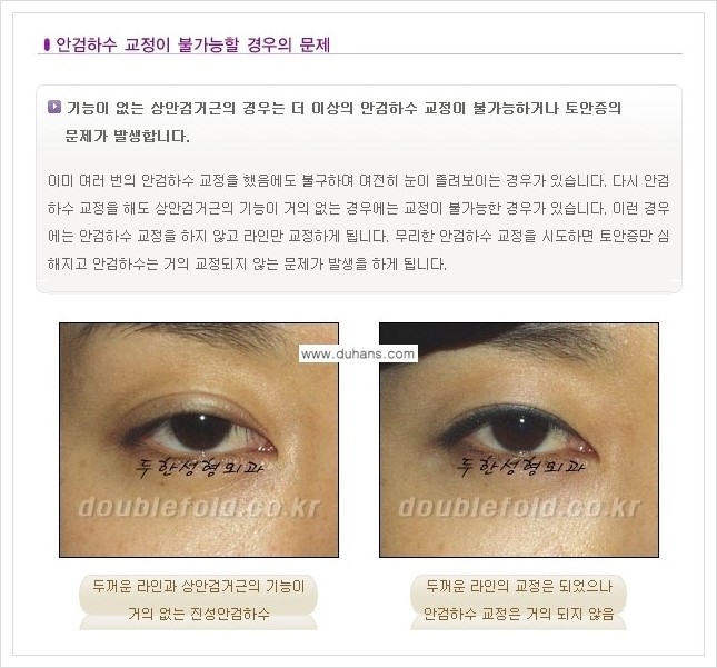 [두한성형외과 경쟁력 쌍꺼풀 재수술, 극한 재수술] - [재수술에서 극복해야 할 극한의 상황과 문제들 안내] 관련 이미지 8