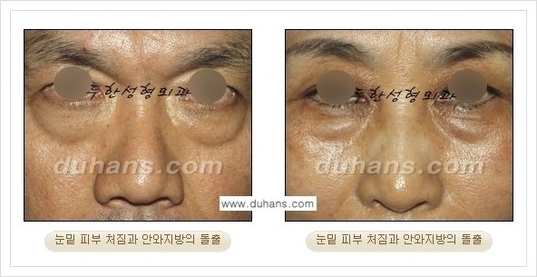 [두한성형외과 경쟁력 동안성형 리더] - ​[미간주름, 이마주름, 안검성형, 이마거상술, 눈썹거상술] 관련 이미지 58