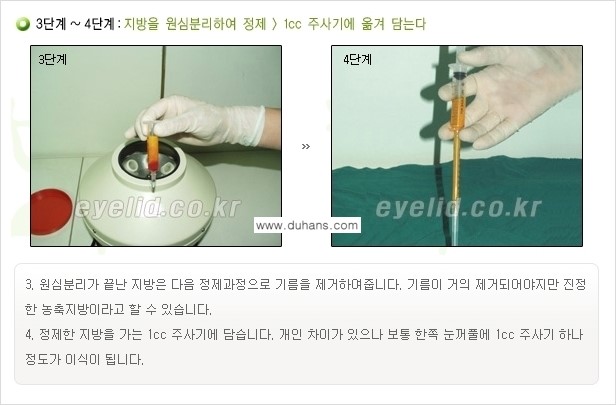[두한성형외과 경쟁력 미세지방이식] - [꺼진(함몰된) 윗눈꺼풀 미세지방이식] 관련 이미지 6