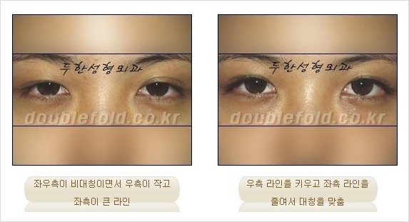 [두한성형외과 경쟁력 쌍꺼풀 재수술] - [짝짝이 쌍꺼풀 라인 교정] 관련 이미지 3