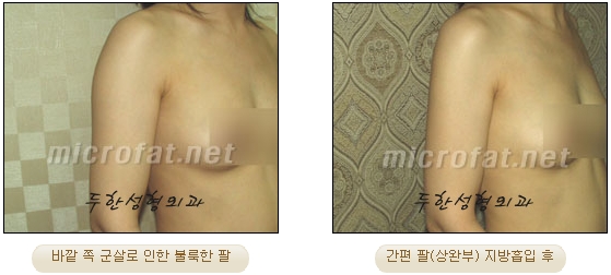 두한성형외과 지방흡입 - 부위별 안전 지방흡입 관련 이미지 24