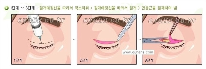 [두한성형외과 경쟁력 눈성형] - [절개법, 매몰법의 수술 방법] 관련 이미지 3