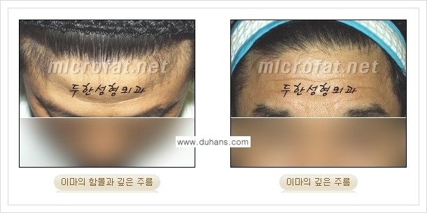 [두한성형외과 경쟁력 미세지방이식] - [부드럽고 아름다운 얼굴 윤곽선 이마(전두부) 미세지방이식] 관련 이미지 3