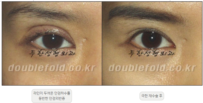 [Duhan Plastic Surgery Double Eyelid Revision] - [Thick Double Eyelid Line] image 53