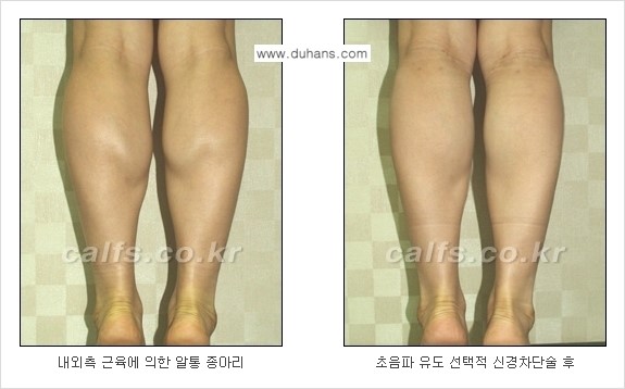 [두한성형외과 경쟁력 종아리성형] - [초음파 유도 선택적 신경차단술 안내 ③] 관련 이미지 8