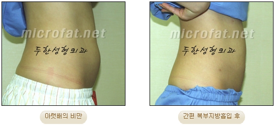 두한성형외과 지방흡입 - 부위별 안전 지방흡입 관련 이미지 20