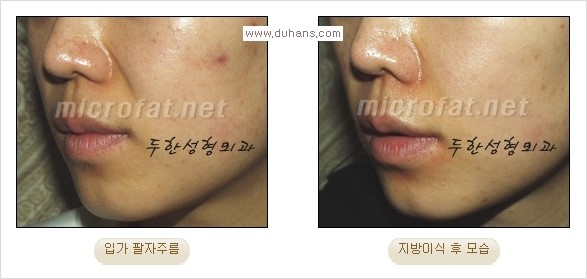 [두한성형외과 경쟁력 주름성형] - [코 옆과 입가에 걸쳐서 형성된 주름을 교정해주는 미세지방이식] 관련 이미지 14