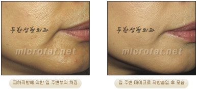 Facial Fat Liposuction at Duhan Plastic Surgery - Cheek Fat Liposuction, Jawline Liposuction, Under-Eye Fat Liposuction image 37