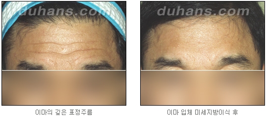 [두한성형외과 주름교정] - [주름개선 지방이식] 관련 이미지 14