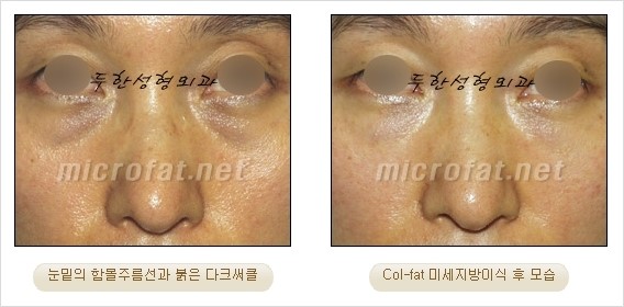 ​[두한성형외과 경쟁력 눈밑성형 리더] - [눈밑 다크써클의 증상, 원인, 종류, 치료방법 안내] 관련 이미지 38