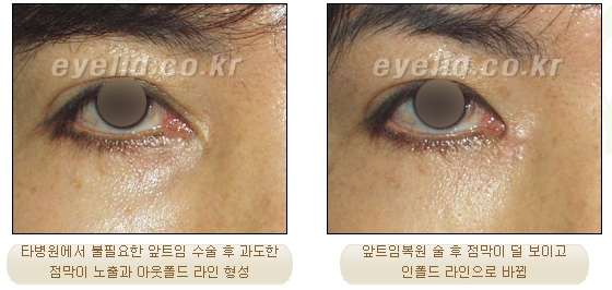 [Duhan Plastic Surgery Eyelid Surgery] - [Epicanthoplasty, Medial Canthoplasty] image 13