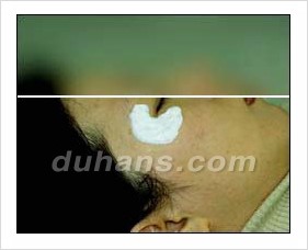 Duhan Plastic Surgery Wrinkle Improvement - Wrinkle Fillers, Juvederm image 5