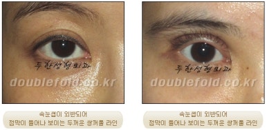[Eye Surgery, Duhan Plastic Surgery] - [Revision Surgery for a Thick Double-Eyelid Line] image 14