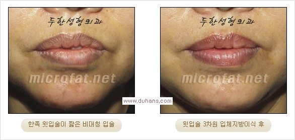 [두한성형외과 경쟁력 미세지방이식] - [입술 3차원 입체지방이식 안내 2.] 관련 이미지 11