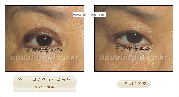 [두한성형외과 경쟁력 눈성형] - [극한의 상태에서 쌍꺼풀재수술(눈재수술) 안내] 관련 이미지 8