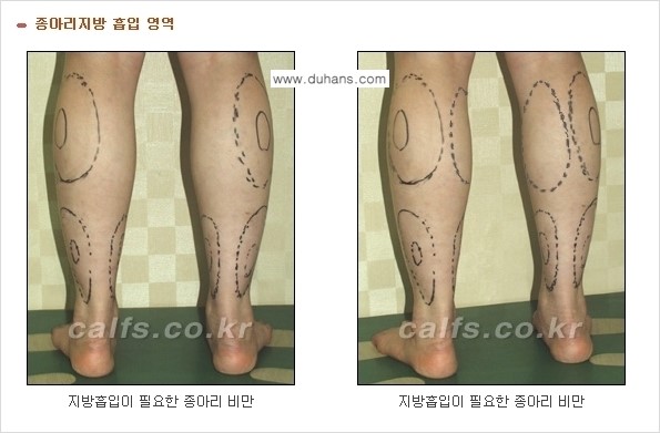 [두한성형외과 경쟁력 종아리성형] - [종아리 지방흡입 1.] 관련 이미지 3