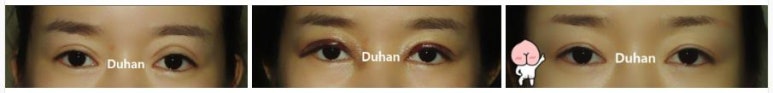 [Duhan Plastic Surgery Eye Surgery] - [Double Eyelid Scar, Double Eyelid Scar Tissue, Revision Surgery for Pigeon Eyes and Ptosis Correction] image 2