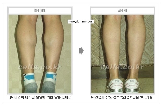 [두한성형외과 경쟁력 멀티종아리성형] - [종아리성형 방법별 전후 주의사항] 관련 이미지 17