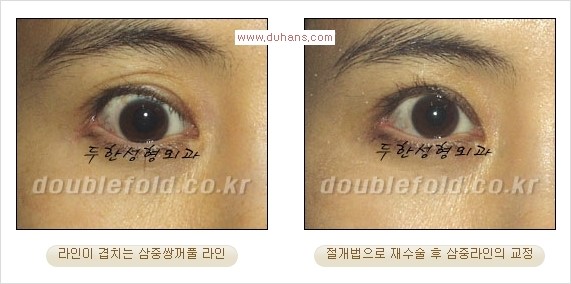 [두한성형외과 경쟁력 쌍꺼풀 재수술] - [삼중(세겹) 쌍꺼풀 라인, 눈꺼풀이 함몰된 삼중(세겹) 쌍꺼풀 라인 교정] 관련 이미지 8