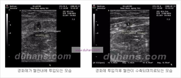 [두한성형외과 경쟁력 정맥류 치료] - [정맥류 치료의 모든 것] 관련 이미지 12