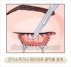 ⁠⁠[두한성형외과 경쟁력 안검성형] - [젊은 눈매를 위한 윗눈꺼풀 지방제거, 눈밑 지방제거] 관련 이미지 15